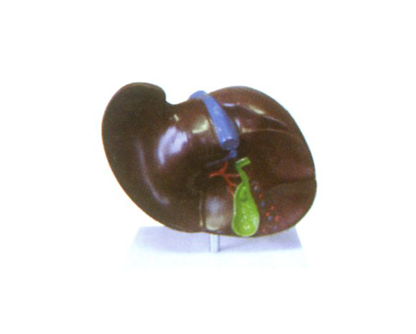 肝膽結(jié)石模型